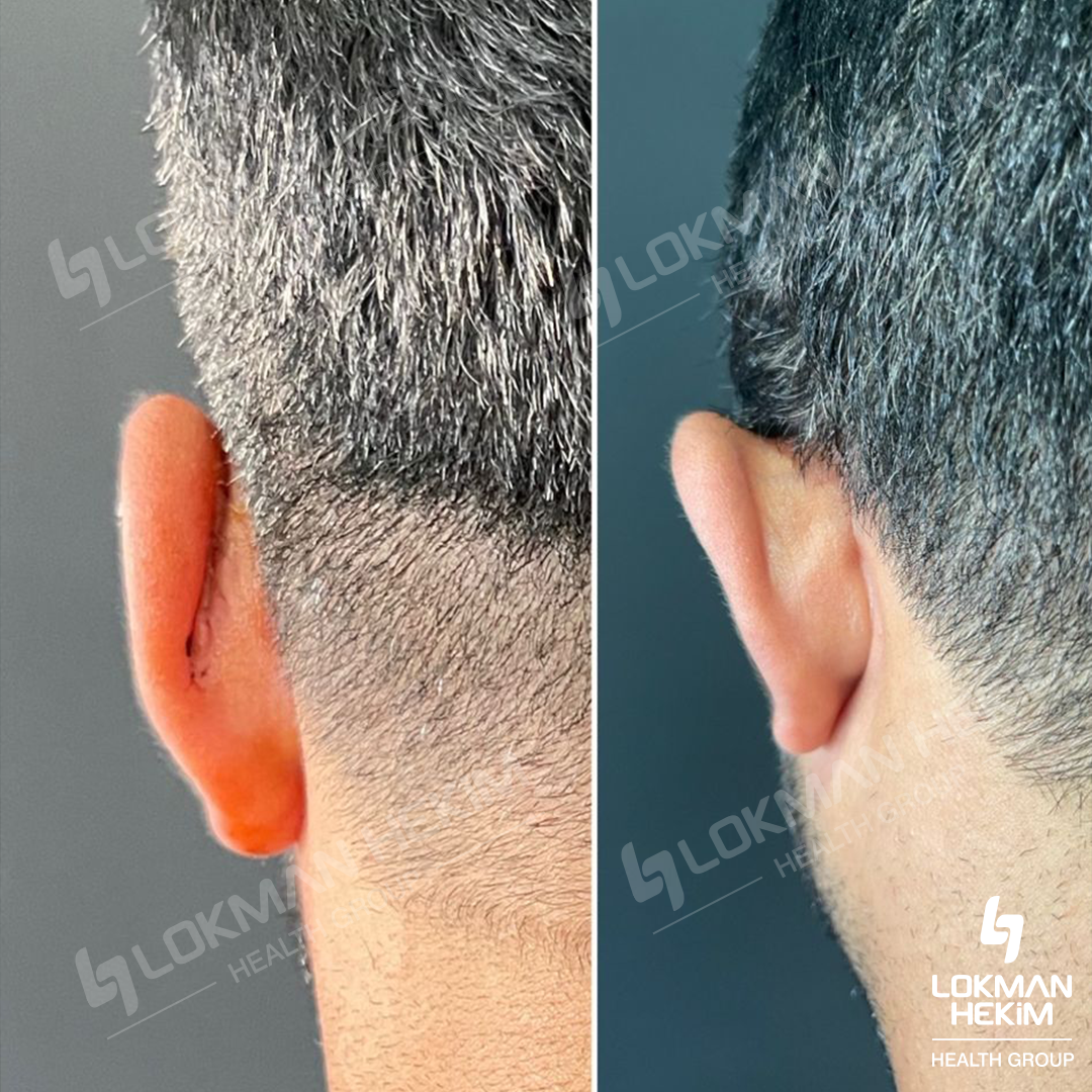 Отопластике (пластике ушей)